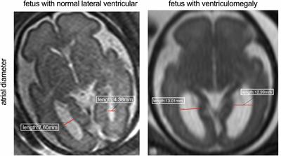 Maternal blood inflammatory marker levels increased in fetuses with ventriculomegaly